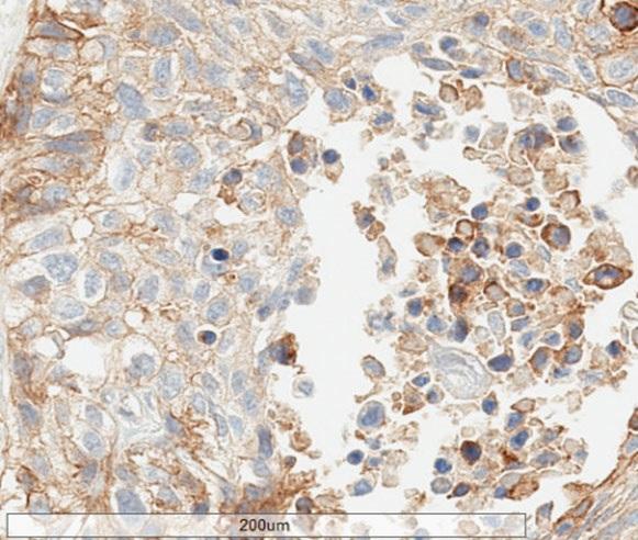 PD-L1, 2 µg/ml (ab205921 batches 6) All batches/lots (1,3,4,5,6) showed consistent results. Note linear and complete or partial (arrows) PD-L1 staining of tumor cells.