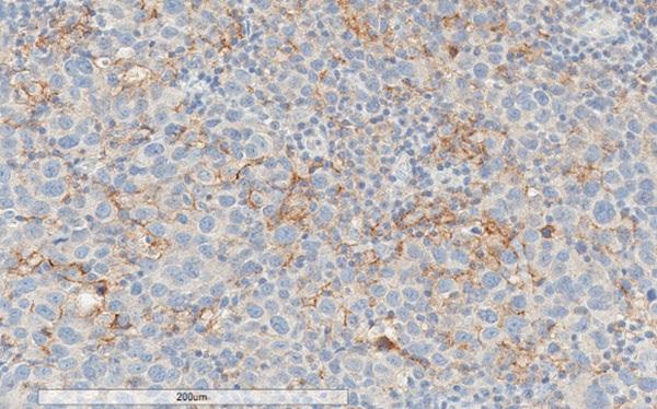 sections) analysis of human melanoma tissue labelling PD-L1 with ab205921.