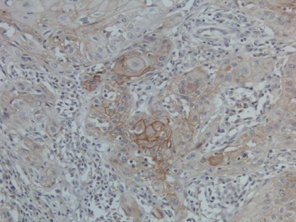 Immunohistochemical analysis of formalin-fixed, paraffinembedded Human head and neck squamous cell