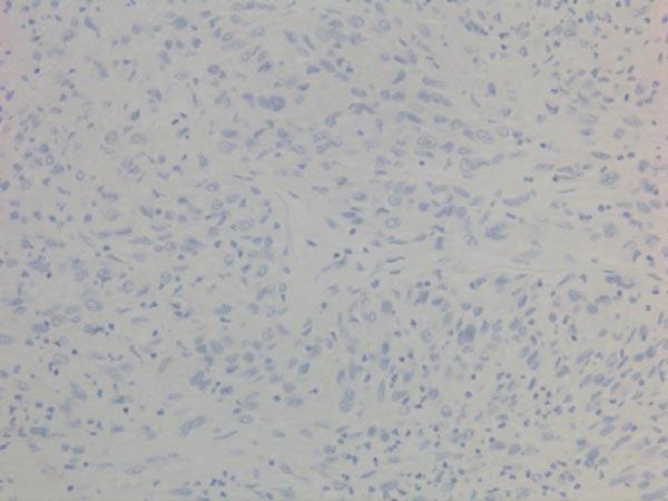 negative Non-small cell lung carcinoma (NSCLC) tissue with ab205921 at 2 µg/ml.