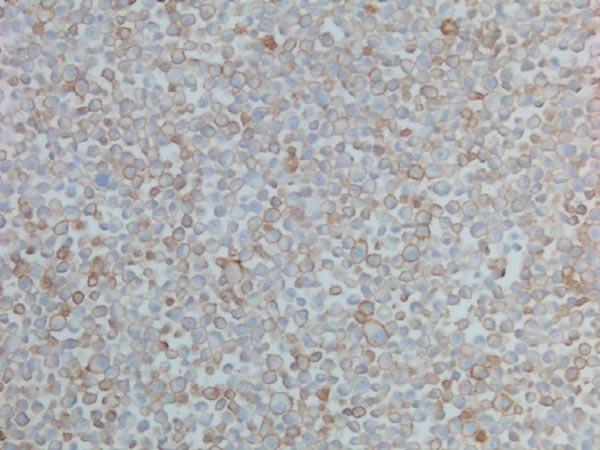 Immunohistochemical analysis of formalin-fixed, paraffinembedded L2987 (Human lung adenocarcinoma cell line with endogenous PD-L1 expression) cells labeling PD-L1 with ab205921 at 2 µg/ml.