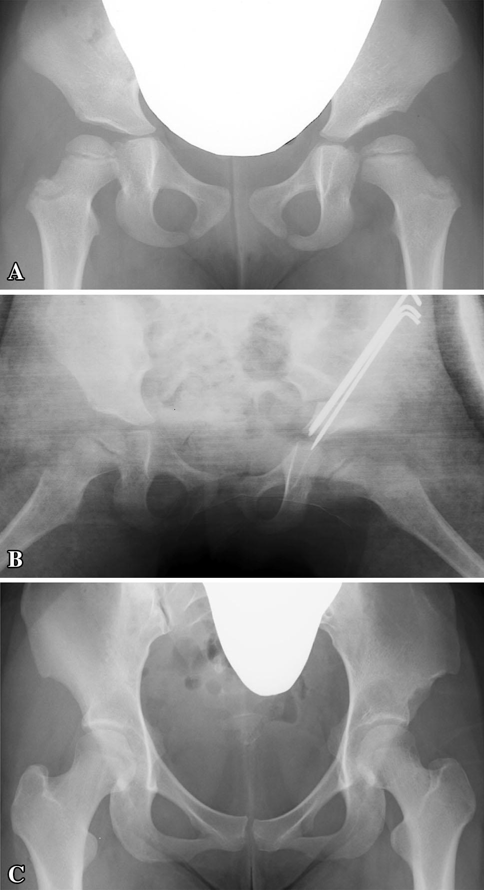 Volume 473, Number 5, May 2015 Postosteotomy Acetabular Retroversion 1757 the patient in the supine position.