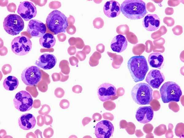 PHYSIOLOGY Chronic myelogenous leukemia (CML) is one of four forms of leukemia. It is caused by a spontaneous somatic mutations, and therefore, non-hereditary.