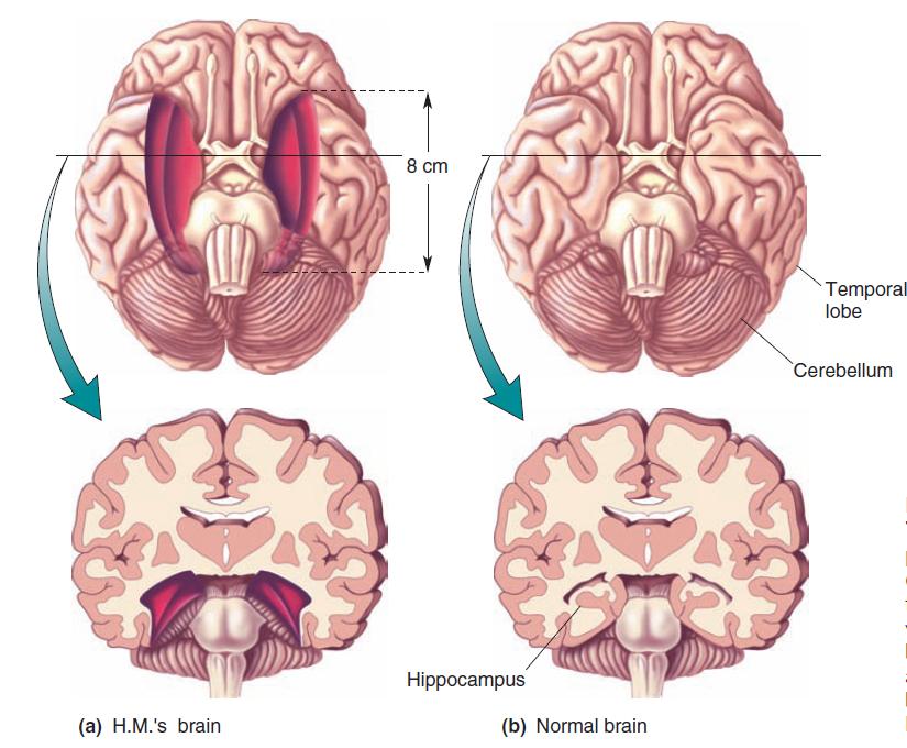 from before surgery CAVEAT: Lesions encompass larger area than just hippocampus 15 http://en.wikipedia.