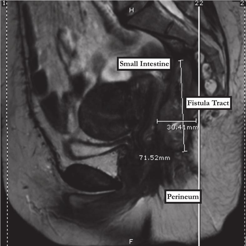 2 Case Reports in Surgery Small intestine Fistula tract Small intestine Fistula tract Perineum Perineum Figure 1: Sagittal view MRI of pelvis demonstrating 7 3cmtract from perineum to presacral space.