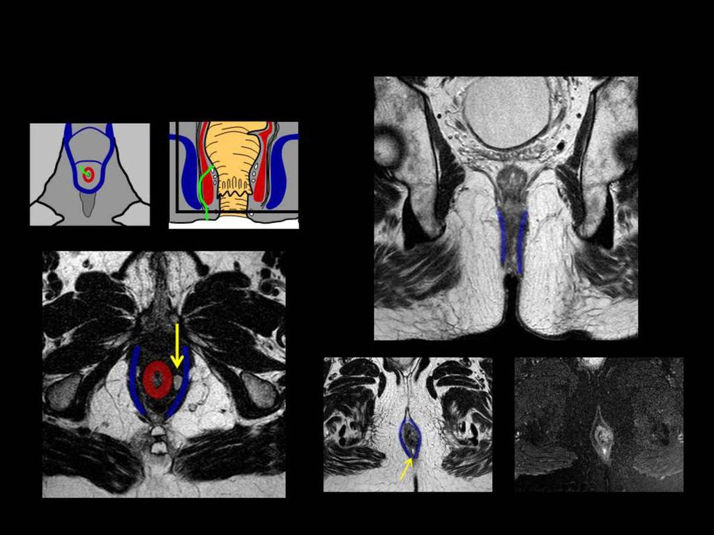 Fig. 3: Axial T2WI, Coronal T2WI and axial FS T1WI with contrast MR image shows a