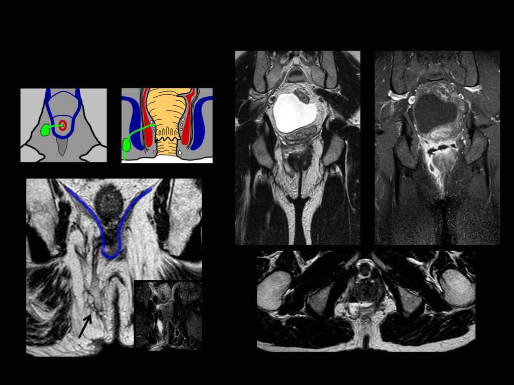 Fig. 6: coronal and axial T2WI, and coronal contrast-enhanced FST1WI, Show a
