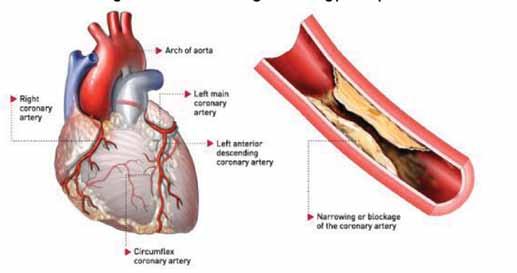 Volumn 8 - Dec 2013 Benefit of Exercise Therapy in Cardiac Rehabilitation Four basic pathologic factors that affect myocardial oxygen supply in coronary artery disease (CAD) patients as following: 1.
