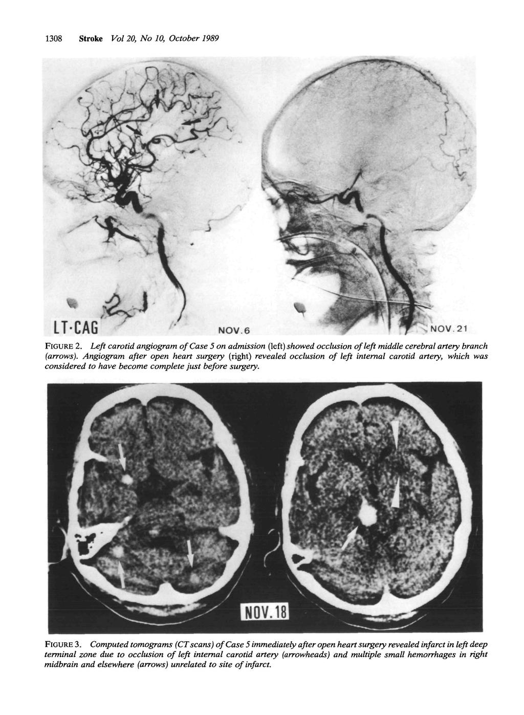 308 Stroke Vol 20, No 0, October 989 NOV. 6, NOV 2 FIGURE 2. Left carotid angiogram of Case 5 on admission (left) showed occlusion of left middle cerebral artery branch (arrows).