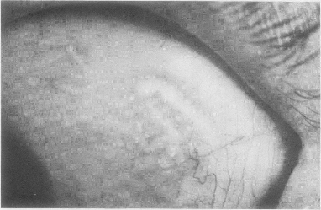 Brit. 7. Ophthal. (i 969) 53, 274 Lymphangiectasia haemorrhagica conjunctivae PHILIP AWDRY Moorfields Eye Hospital, Ci