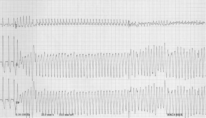 Ventricular tachycardia (VT) Tachycardia (>180 beats/min) Wide and bizarre QRS complexes Absent P waves Reason to