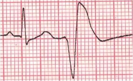 Chronic Management of VT Assess for an underlying cause First-line oral antiarrhythmic