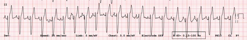 Mistaken Identity Accelerated idioventricular rhythm (heart rate not rapid)