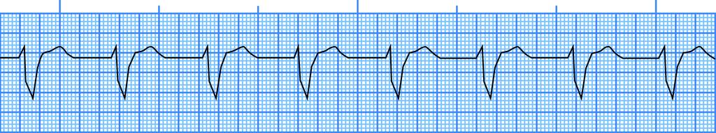 after several episodes of syncope PE Paroxysms of tachycardia auscultated II