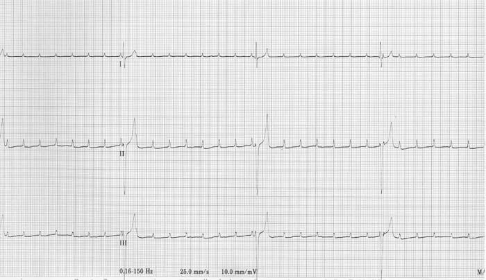 (nonconducted P waves) P waves and QRS complexes are unrelated (no consistent PR interval) Escape rhythm ECG diagnosis: 3 rd degree AV Block 3