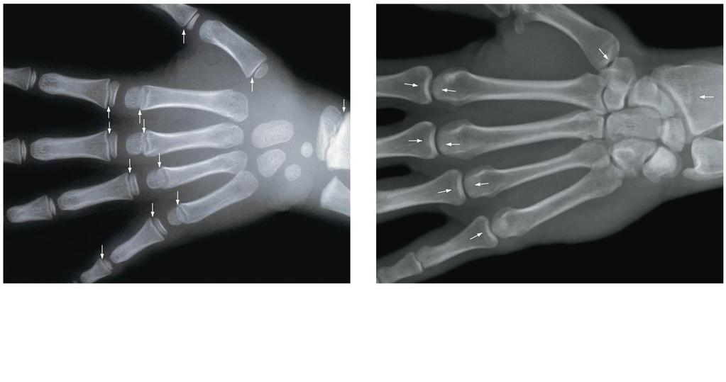 Figure 5.8 Epiphyseal Cartilages and Lines a X-ray of the hand of a young child.