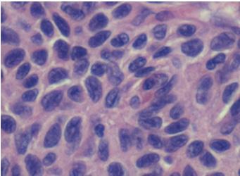 6: right ovary (H&E): Tumor cells with