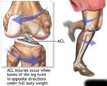 of the knee against anterior translation Typically injured from a rotational or hyperextension