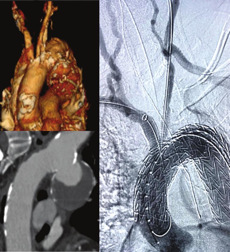 COURSE DESCRIPTION The UCLA Symposium on Advances in Treatment of Aortic Pathology, sponsored by the UCLA Aortic Center, is a one-day self-assessment CME course that will present advances in