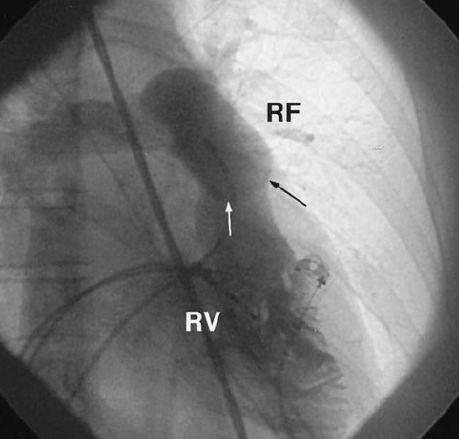 Pulmonary artery VT PV PV RAO LAO Taller R in II, III, avf 1.89~1.92 mv vs 1.49~1.