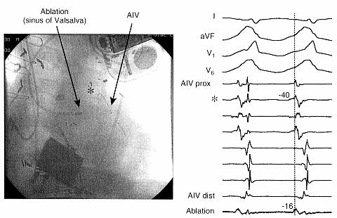 Epicardial origin of LV VT Multipolar catheter in Ant.