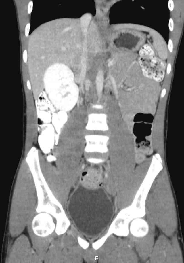 Case Reports in Pediatrics 3 (a) (b) Figure 2: Contrast enhanced abdominopelvic CT scan. Two contiguous coronal reformations showing patent suprarenal inferior vena cava (white arrow).