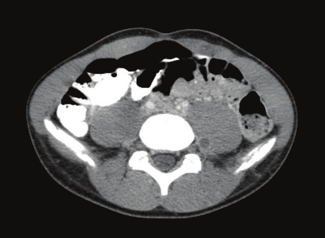 (3) Azygos continuation of the IVC has also been termed absence of the hepatic segment of the IVC with azygos continuation. The prevalence is 0.6%.