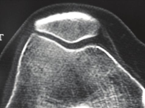 to the knee such as, a direct blow to the patella, a fracture, or a dislocation of the patella.