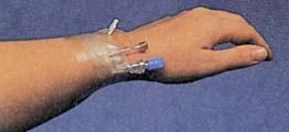 Equipment Choosing best size over-the-needle catheter Smaller-sized devices are better Except for volume replacement Causes less injury Allows greater blood flow Large-bore catheters Shock Cardiac