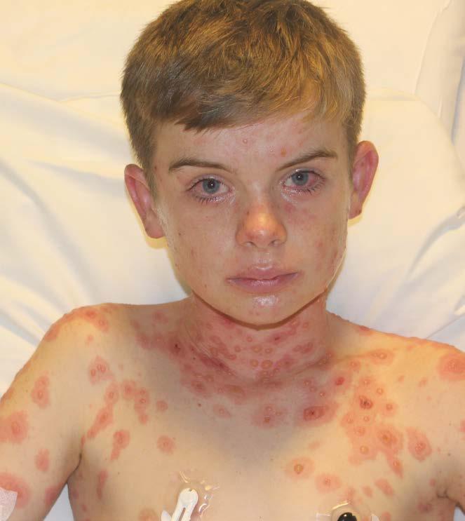 Case 1 14-year-old previously healthy male returning from Spanish camp with rash, fever,