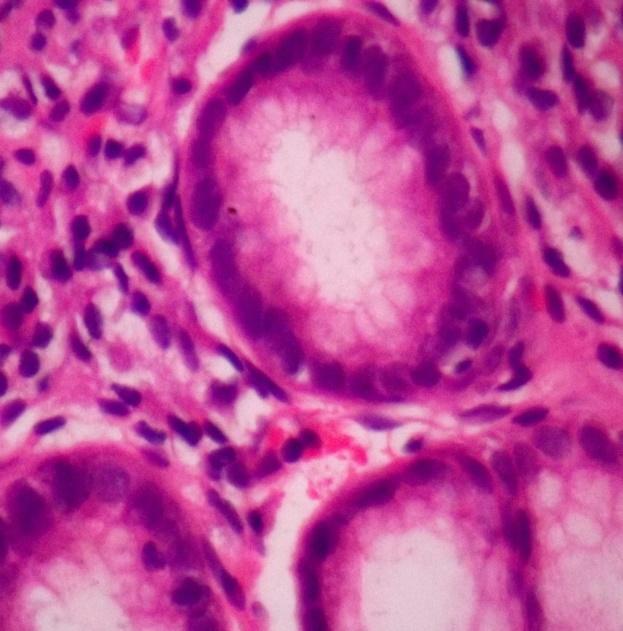 Male to female ratio was 3:2.Table 2 In H& E stained sections, curvilinear, eosinophilic organism was seen in the mucous layer of gastric lining epithelium. Figure 3.