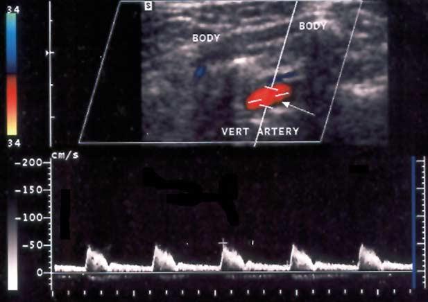 1108 Kalaria et al October 2005 Figure 3 Latent subclavian steal syndrome (partial stenosis) with early systolic deceleration (dip marked by arrows) is reflected in systolic flow portion of Doppler
