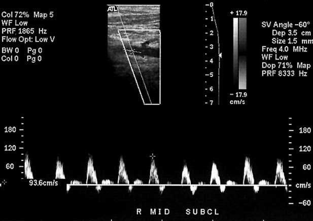 1110 Kalaria et al October 2005 Figure 8 Normal subclavian artery Duplex waveform.