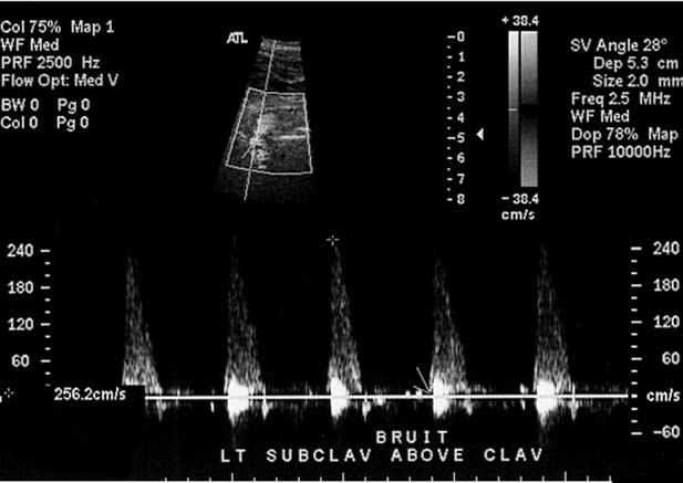 11 Low-amplitude, monophasic waveforms are suggestive of preocclusive subclavian stenosis.