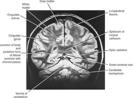 Coronal MRI