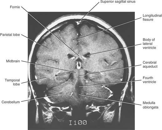 A coronal MRI (contrast enhanced) through the hindbrain showing