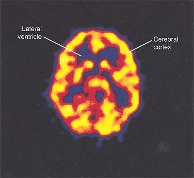 Axial (horizontal) PET scan of a normal brain following the injection of 18- fluorodeoxyglucose.