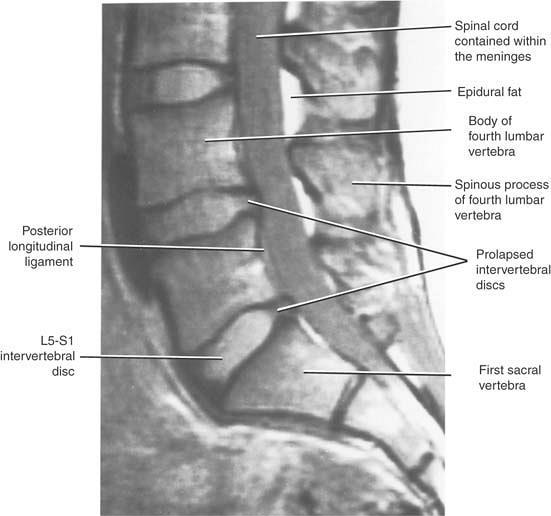 Sagittal MRI of the lumbosacral part of the vertebral