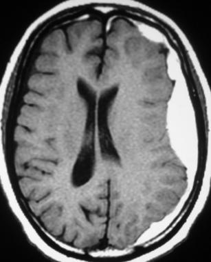 MRI showing fronto