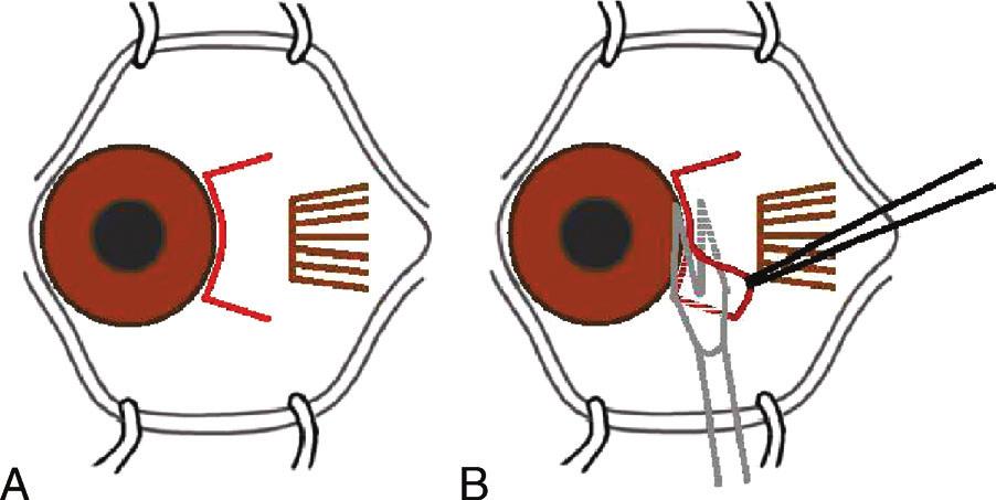 Sami FIGURE 1. A and B, Limbal approach. 2 A, The limbal incision (outlined in red).