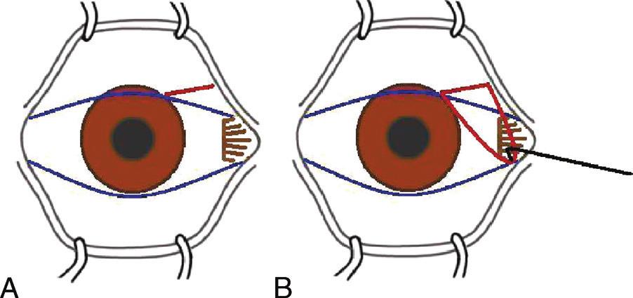 The blade is then moved anteriorly toward the limbus, to perform a peritomy. FIGURE 3. A and B, Radial incision. 12 The incision is outlined in red.