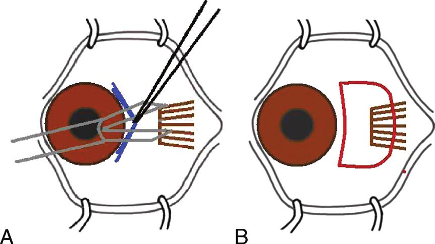 Conjunctival Incisions for Strabismus Surgery FIGURE 5. A and B, One-snip, horseshoe-shaped incision.