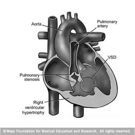 28 Transposition of aorta/a. pulmonalis Two parallel circulations! aorta systemic circulation v.