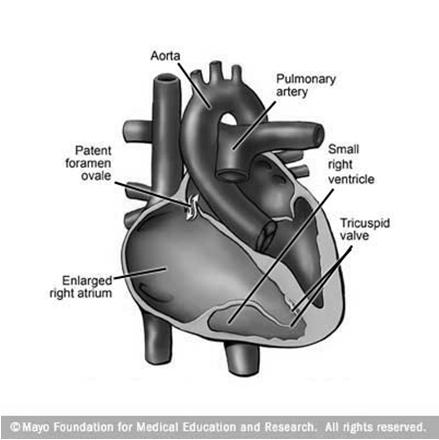 Ebstein Endocardial cushion defects Important for the development of AV region, lower part of atrial and upper part of ventricular septum Abnormal developent is responsible for cca 5% of congenital