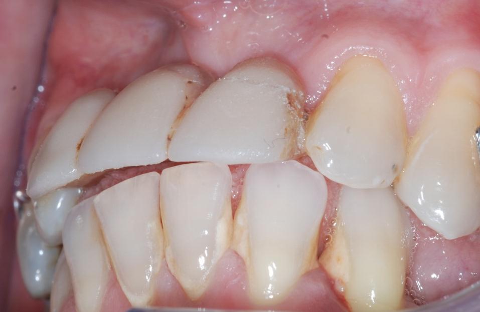 occlusal contact on