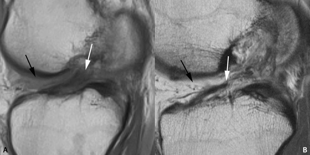 155 Figure 72 5 and less discrete fiber definition in Fig. 72 6B (arrow). Arrowheads mark the proximal ACLs in both cases.