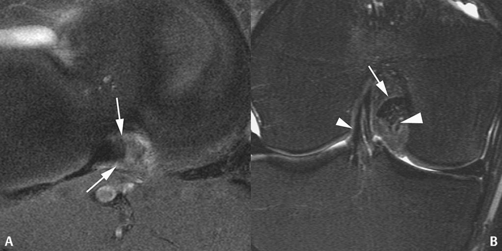157 Figure 72 7 Complete disruption of the PCL occurs with posterior knee dislocation and is frequently associated with a medial gastrocnemius tendon tear.