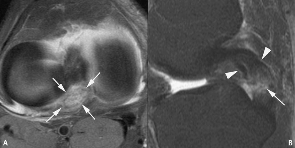 Figure 72 8A is another axial proton density fat-saturated image of a right knee, this time demonstrating complete disruption of the PCL.