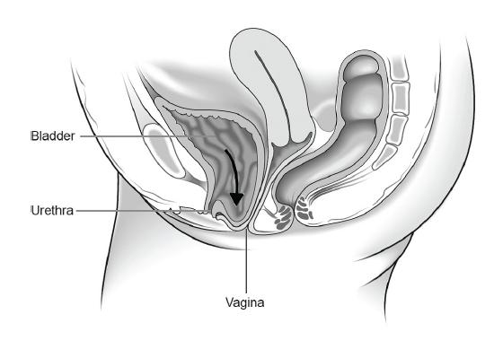 The uterus, bladder, or rectum may be involved.