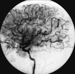 years pos-embolization and